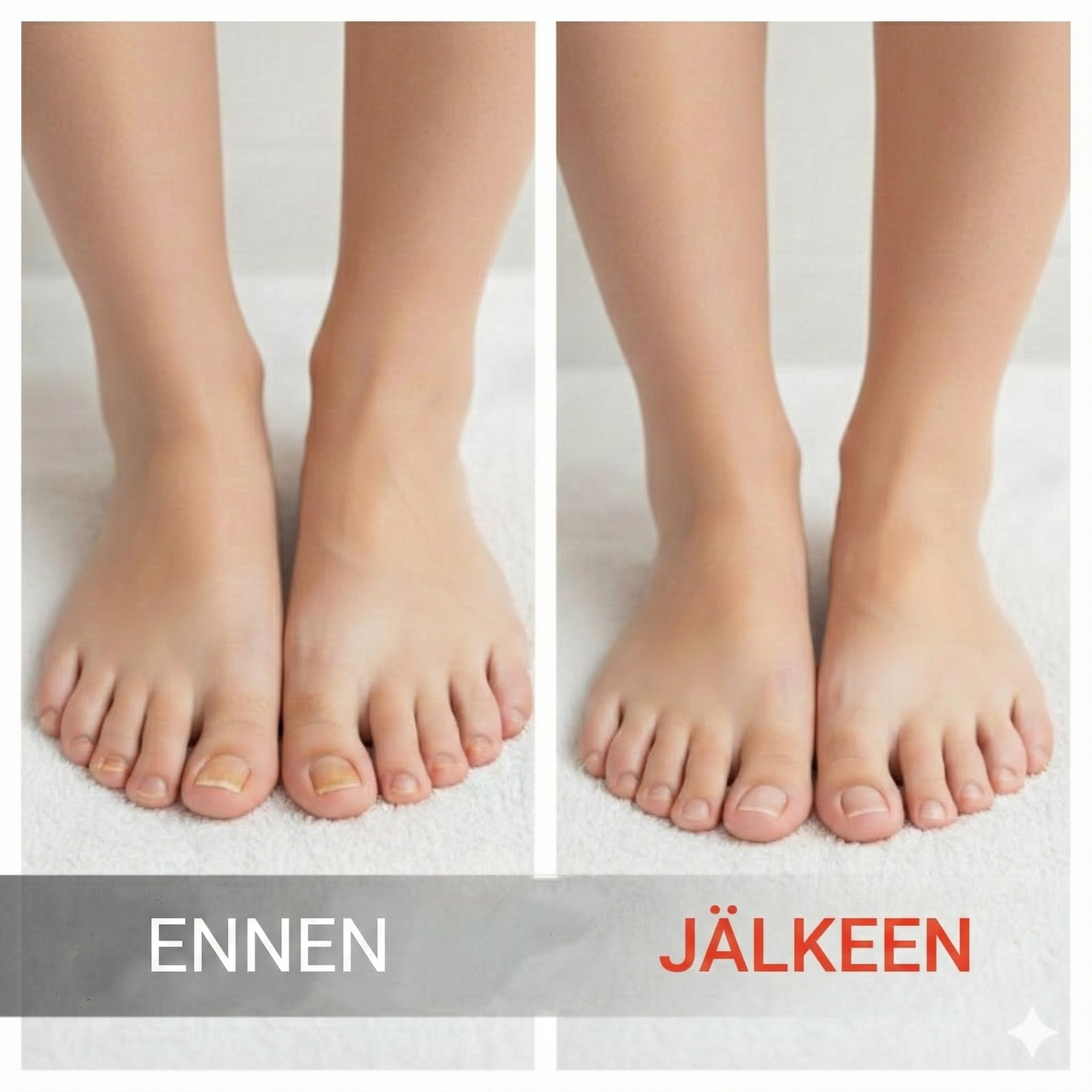 Kynsien korjausesanssi vaurioituneille kynsille