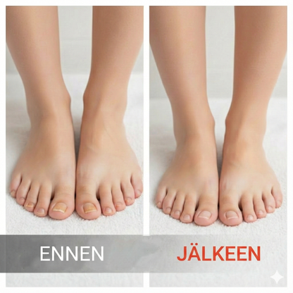 Kynsien korjausesanssi vaurioituneille kynsille