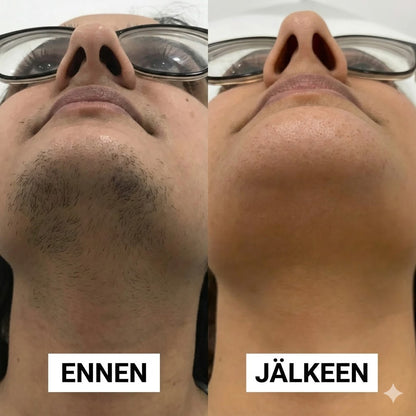 Hellävarainen ja kivuton kasvojen karvanpoistovoide